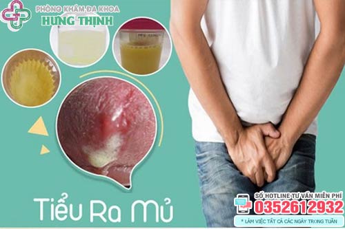 Đi Tiểu Ra Máu: Dấu Hiệu Của Bệnh Tiết Niệu Cần Cảnh Giác