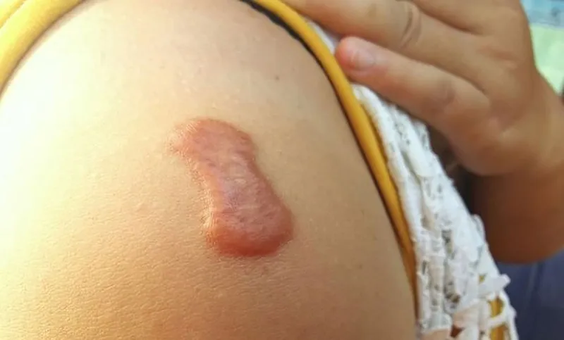 Vết thương hở ăn thịt bò được không? Hướng dẫn dinh dưỡng an toàn 1