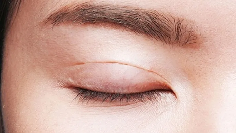 Thời gian kiêng thịt bò phụ thuộc vào giai đoạn phục hồi và đặc điểm cơ địa