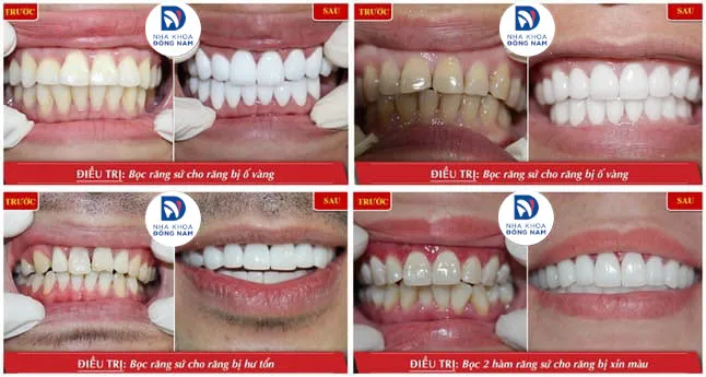 Kết quả bọc răng sứ