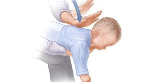 Sơ cứu trẻ bị hóc dị vật